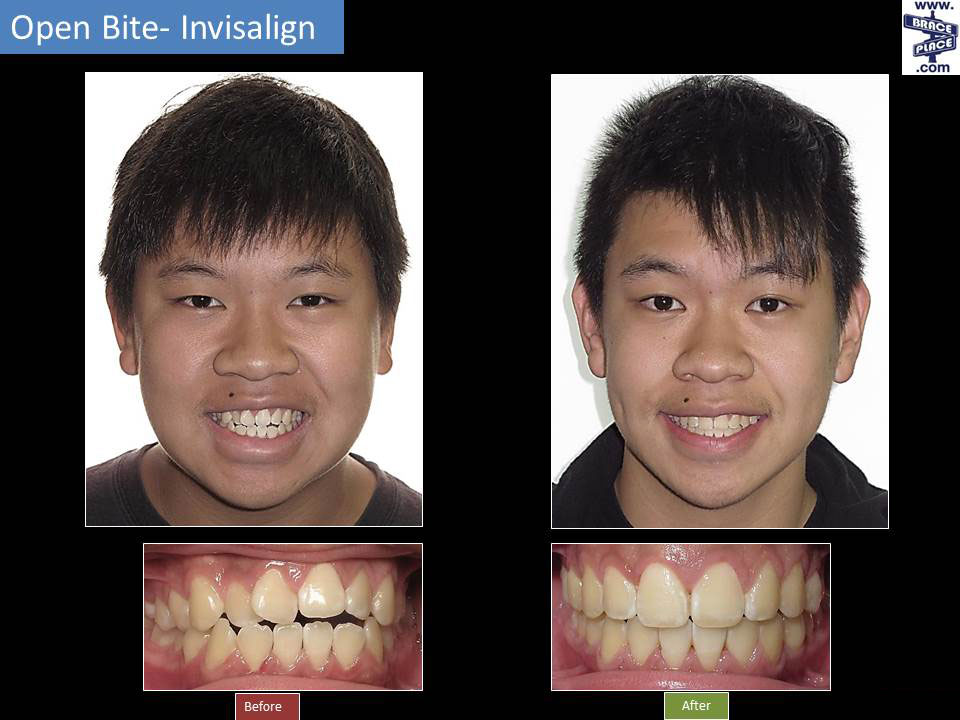 Invisalign® Before & After, Freehold Hightstown Manalapan NJ Orthodontist