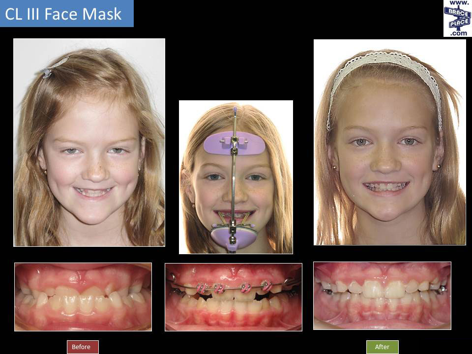 Dramatic Improvement After Early Orthodontic Treatment